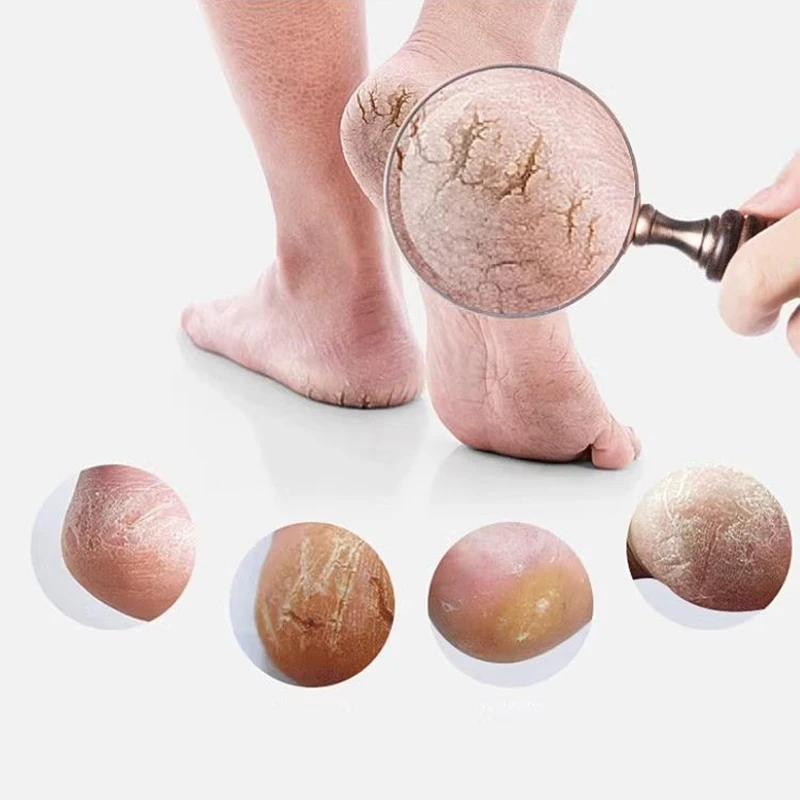 젤 풋 케어 양말, 통증 완화, 균열 방지, 보습, 각질 제거, 천공 실리콘 풋 케어 도구, 1 쌍