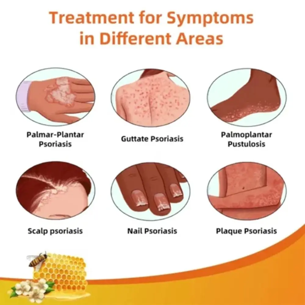 Repair Hands and Feet Skin Moss Bee Venom Psoriasis Cream Smooth Moisturizing Bee Venom Cowhide Moss Cream Red Itchy Skin Care