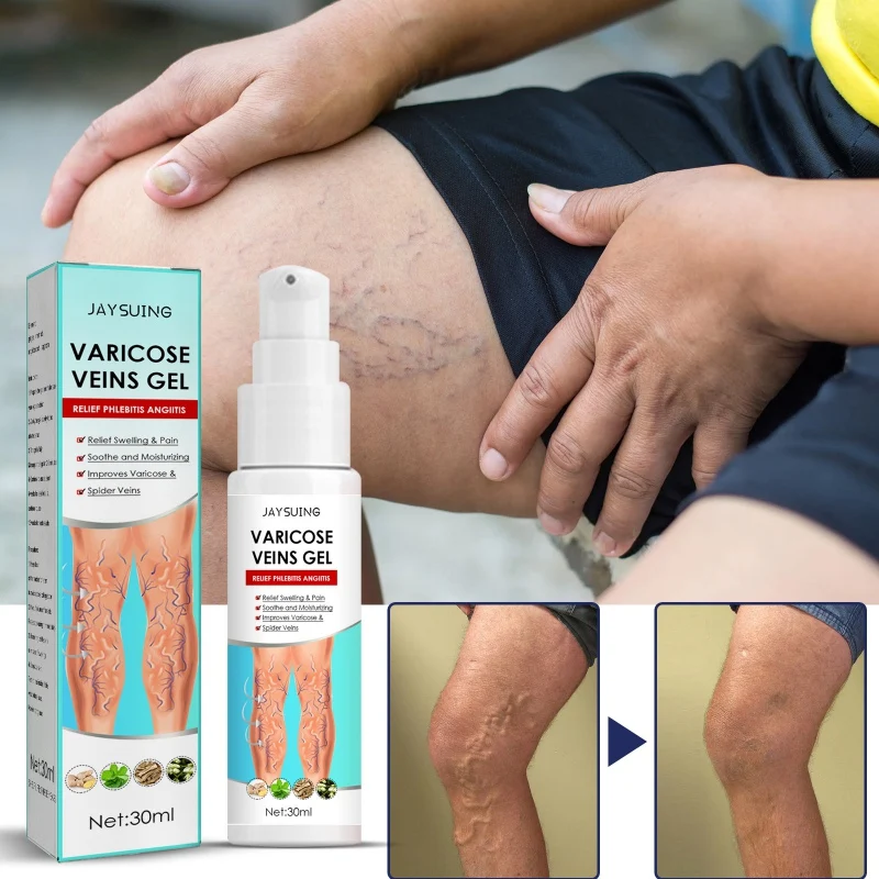 Feet Varicose Veins Cream Treatment Gel Relieve Dilated Capillaries Removal Phlebitis Spider Leg Veins Varicose Cream.jpg