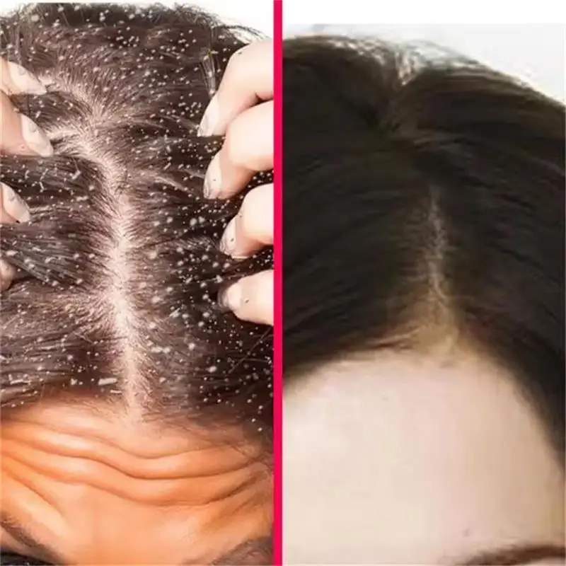 Hair Scalp Treatment Essence Anti Dandruff Itching Oil Control Anti Loss Scalp Cleaning Repair Serum Beauty Hair Care Products