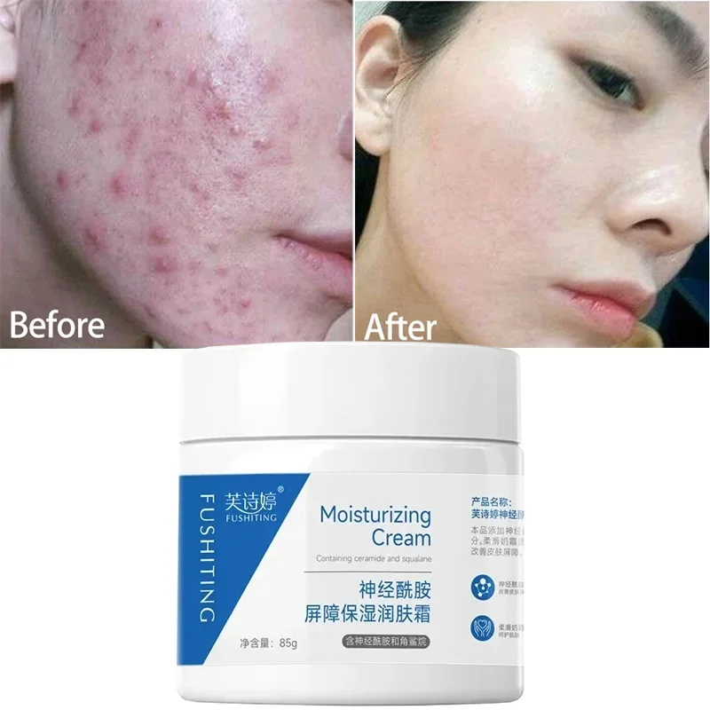 Instant Facial Redness Treatment Cream Remove Acne Red Blood Whitening Repair Products Anti Spider Vein Sensitive Skin Care