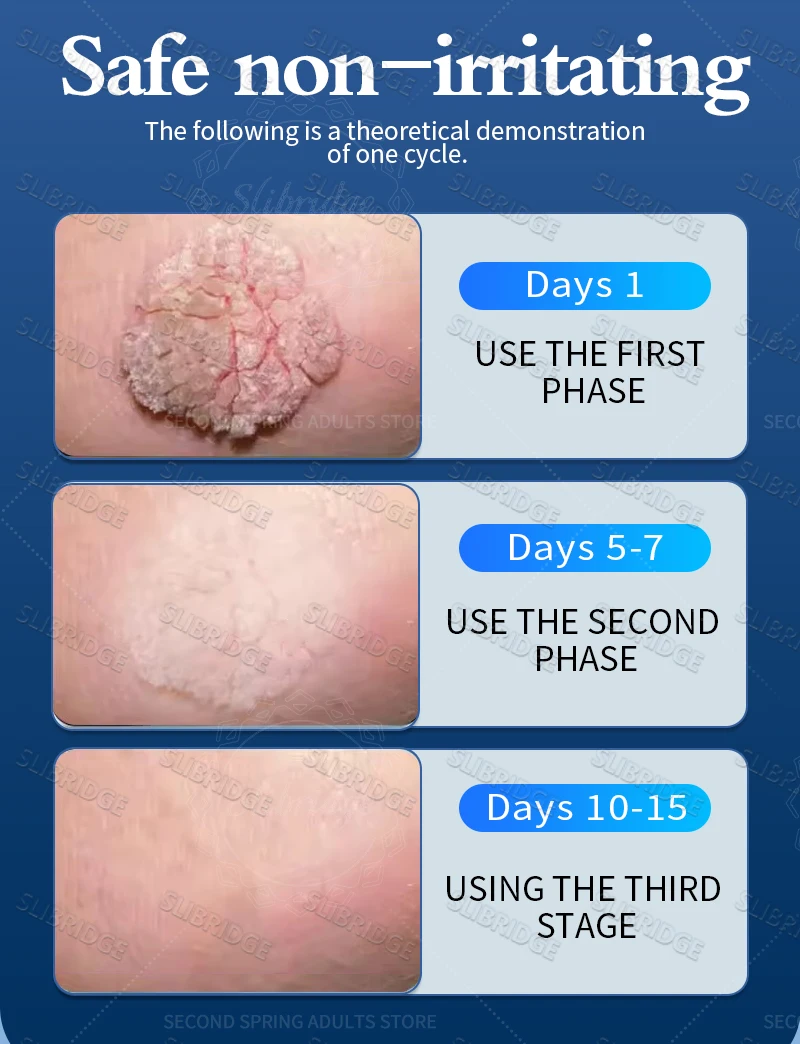 Flacone blu sicuro ed efficace per rimuovere le verruche, strumenti per il corpo, congelamento delle verruche._voghion.com