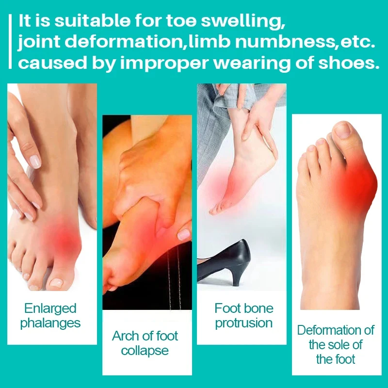 ZB 20g Foot Gout Treatment Cream Thumb Corrector Finger Hallux Ointment Toe Bunion Pain Relieve Medical Plaster Health Care