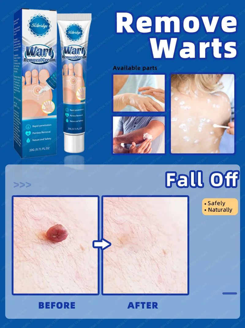 WartRemoverCreamRemoveGenitalWartsFiliformFlatPeriungualHPV