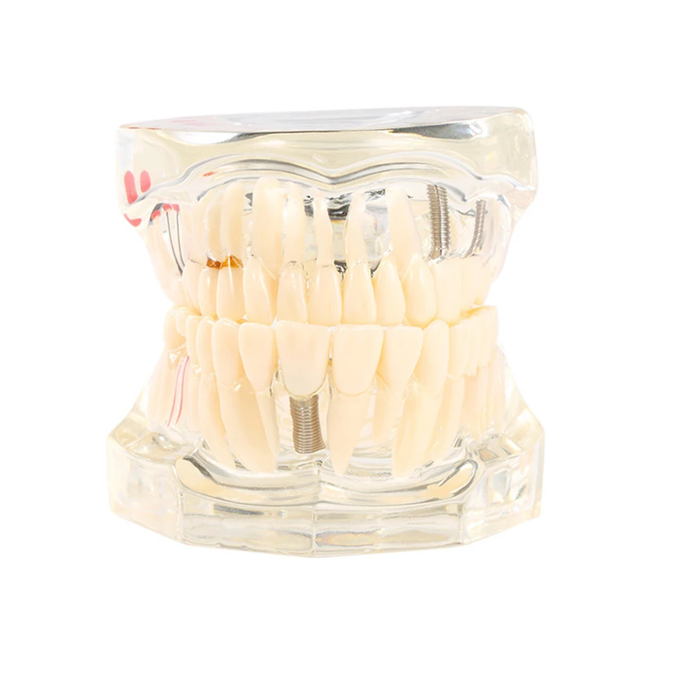 Dental Models Removable And Restorable Models Of Diseased Teeth For Teaching And Researching Medical And Dental Diseases