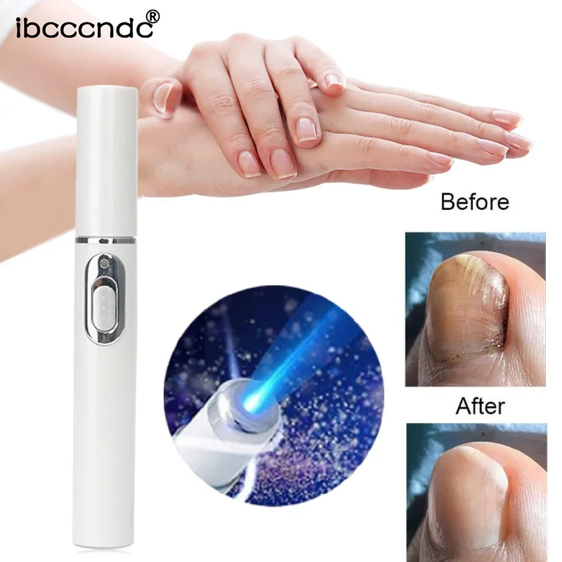 Nail Fungal Pen Anti Fungus Blue Light Laser Pen Onychomycosis Painless