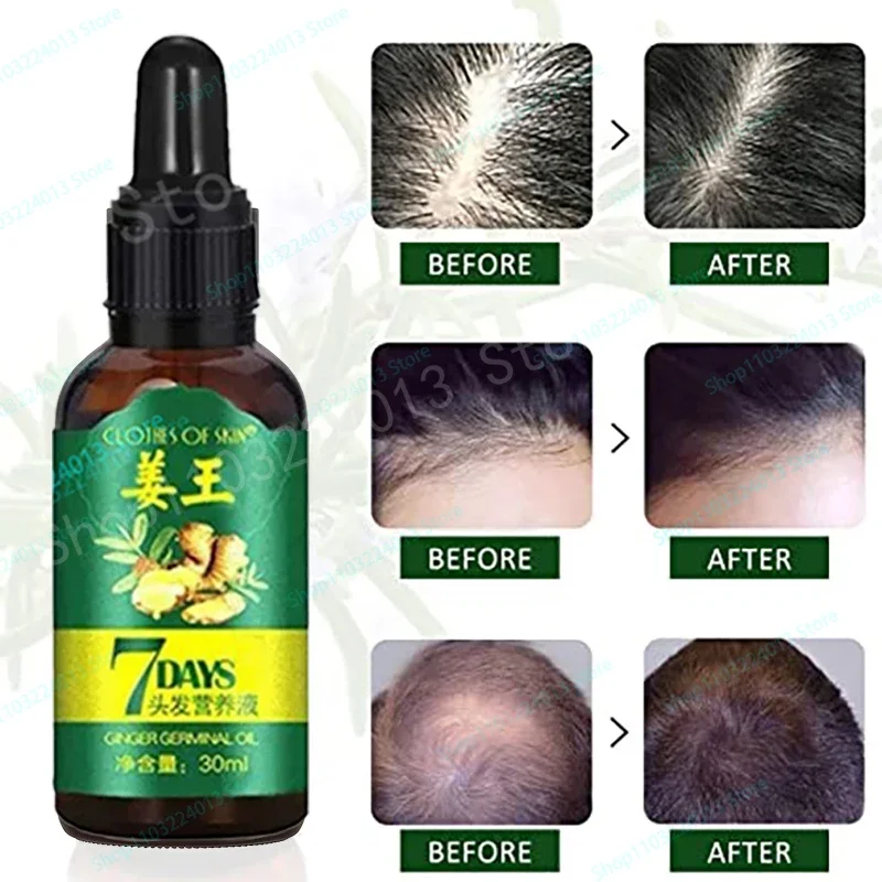 

Strong Effect Turmeric Hair Growth Products Ginger Essential Oil Treat Hair Loss Scalp Repair Nourish Hair Roots Regrowth