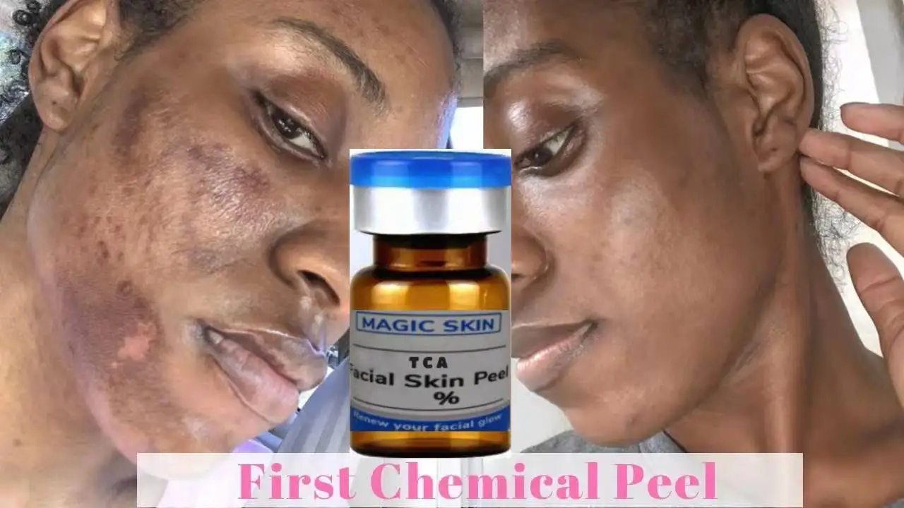 

Tca Acid Peel Spots Exfoliating Reduce Wrinkles Acne Scars Enlarged Home Chemical Peel Kit Beauty Health Skin Acid Face Peeling