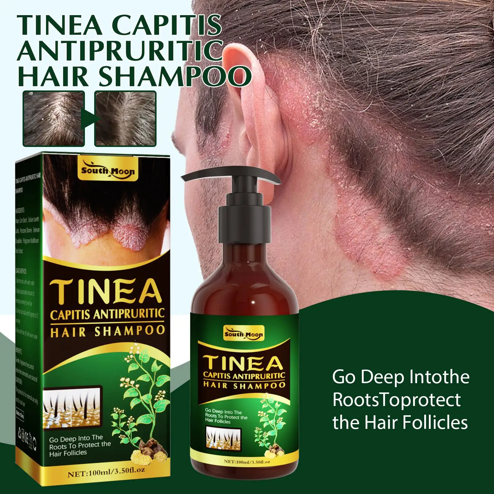 Folliculitis Scalp Shampoo