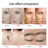 Lescolton LS-831 Silver / LS-830 Gold / LS-058 Facial Skin Care Beauty Device For Face  Body Skin Tags Removal Dropshipping 2