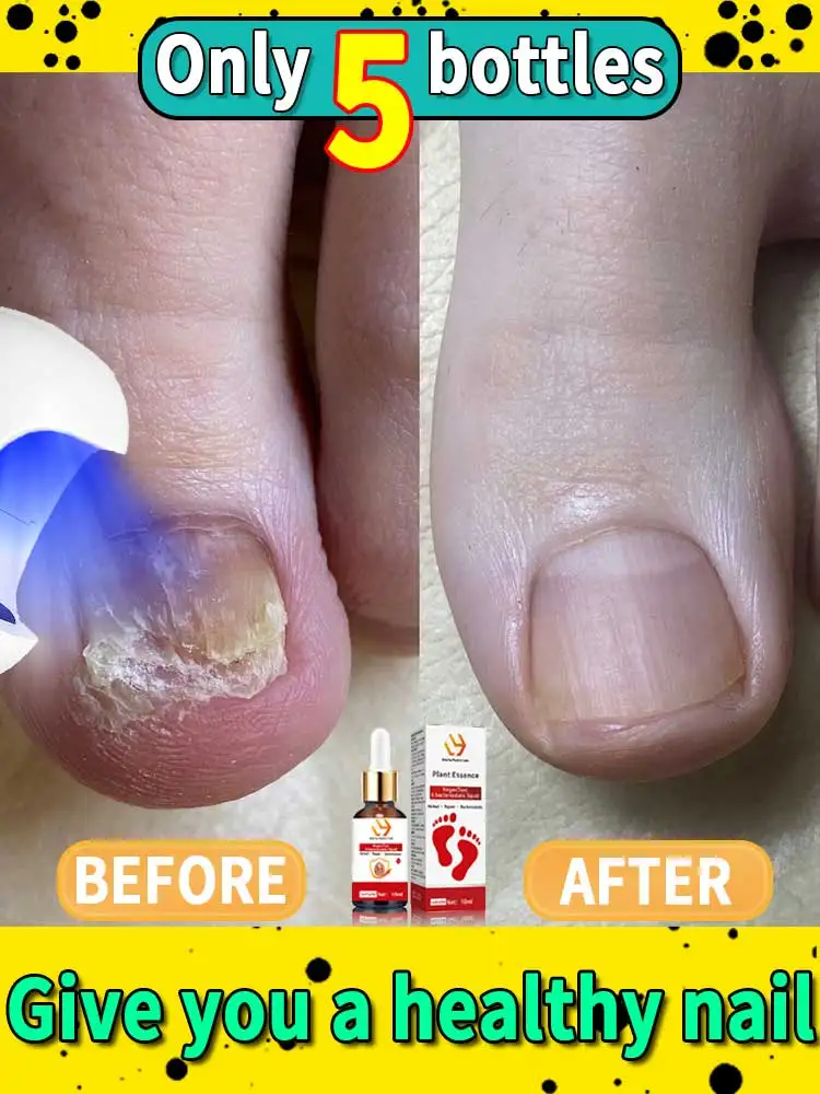 Portable nail cleaning equipment, professional nail laser irradiation, accessories