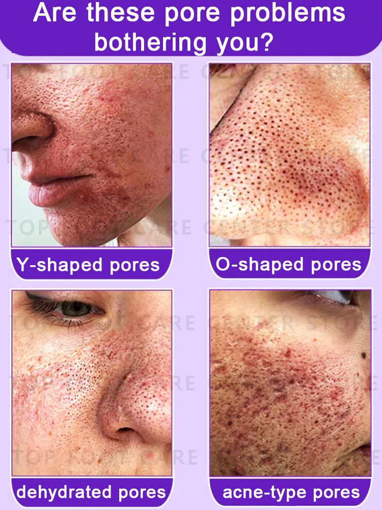 Large pores problem 2