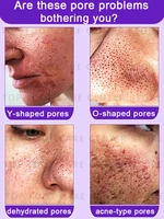 Large pores problem 2