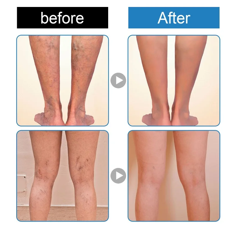 Spray for Varicose Veins Effective Varicose Vein Relief Cream Relieve Leg Vasculitis Phlebitis Spider Pain Swelling Treatment