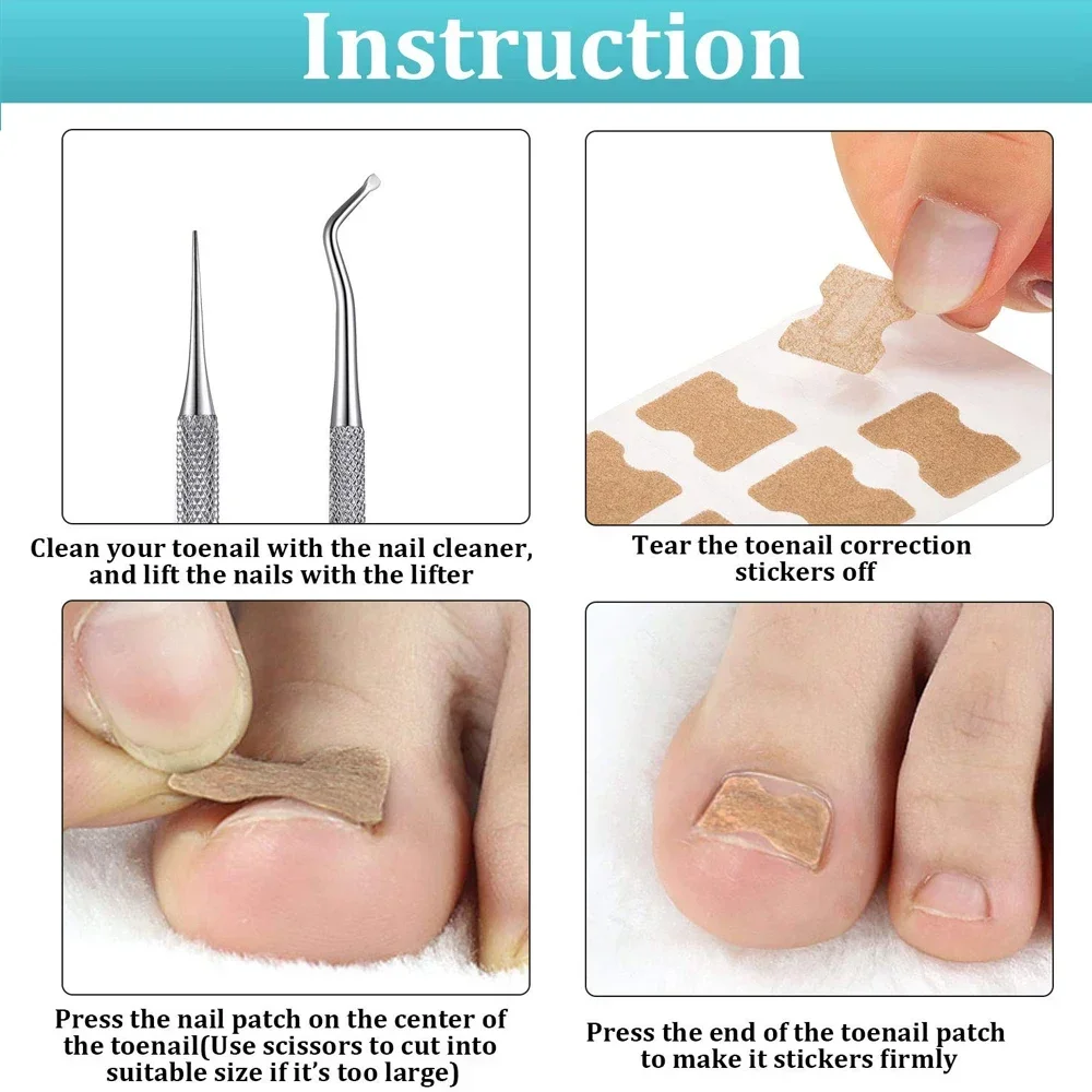 Ingrown Toenail Correction Patch Stickers Ingrown Toenail Treatment Lifter Toe Nail Patch Correction Buckle File Cuticle Pusher