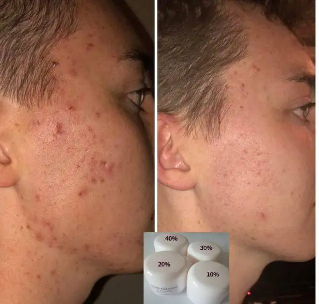 La Crema Di Acido Glicolico Al 60% Esfolia La Pelle-Illumina, Riduce I Pori. Glicolico Naturale, Cogico, Acido Salicilico, Retinolo, Arbutina