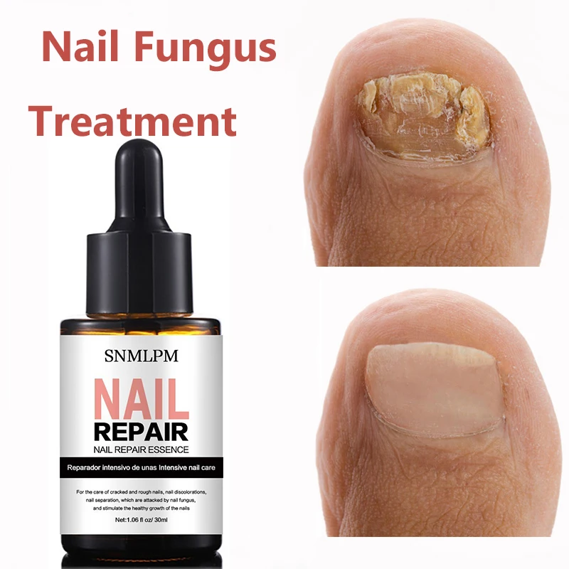 Nail Fungal Treatment Feet Care Essence Anti Infection Paronychia