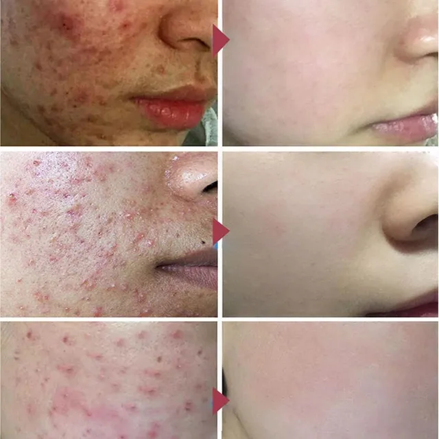 10Db Gyógynövényes Pattanás Krém Foltok Domborművészete Az Acne Anti-Acne Hidratáló Gél Pórusának Minimalizálása A Koreai Bőrkrém 20 G - Image 6