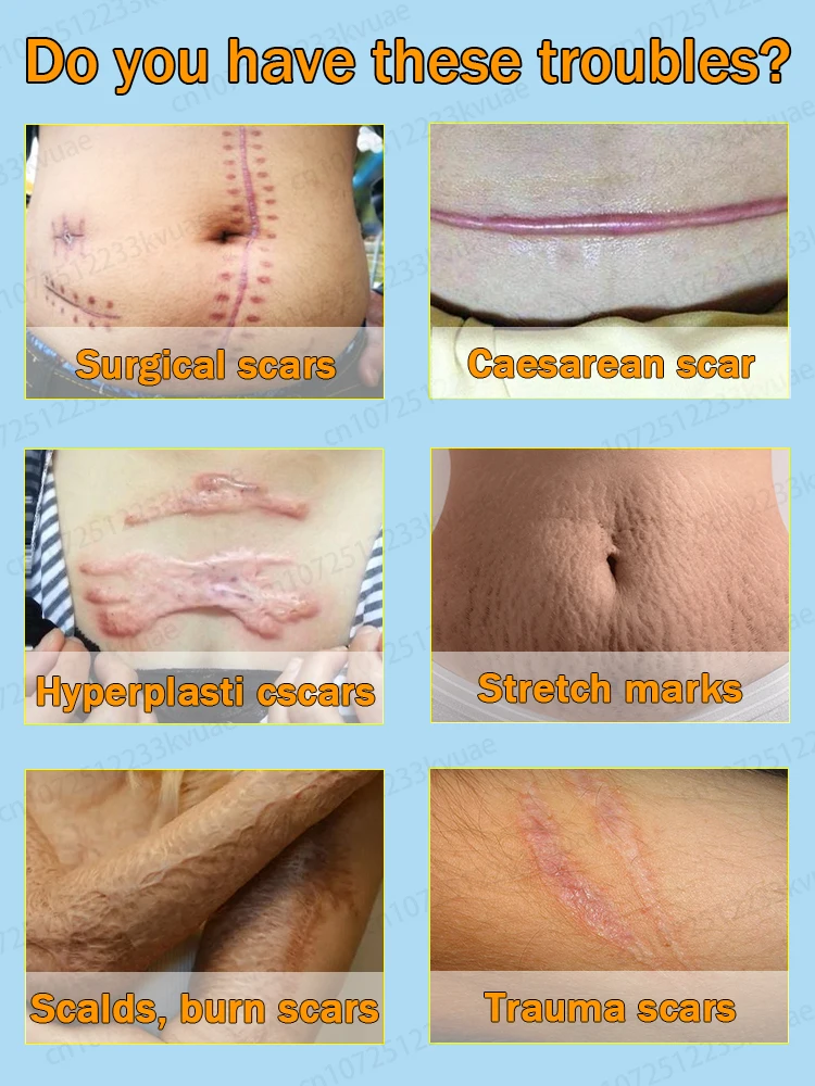 Scar Cream Remove All Scars
