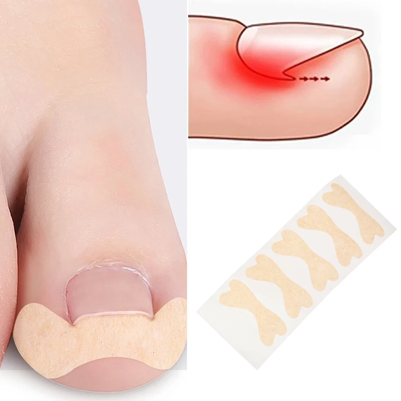 Correttore dell'unghia incarnita adesivo correttore per unghie intarsio per dita dei piedi Patch per unghie trattamento paronichia recuperare adesivi per la correzione del correttore