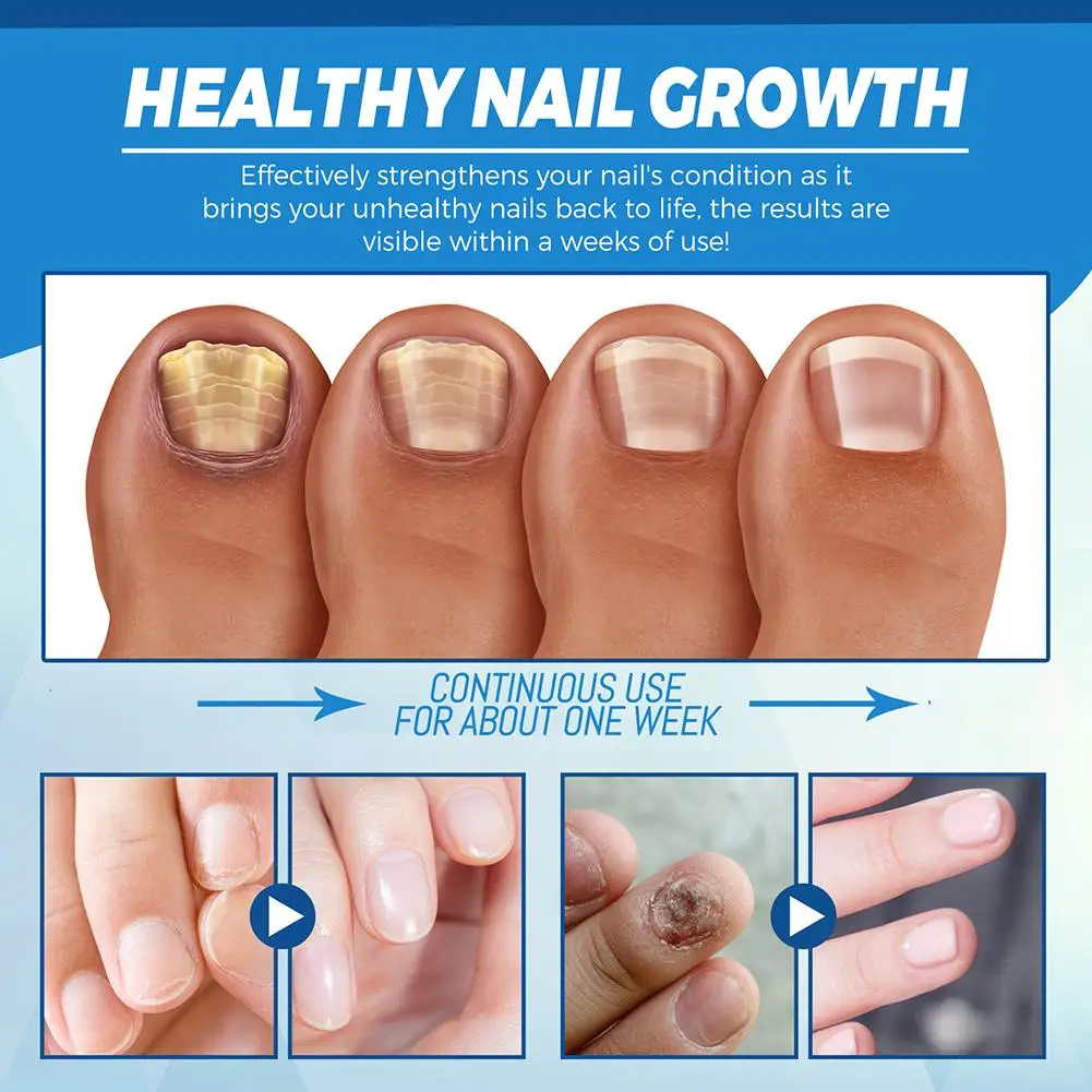 Nail Fungus Treatment Pen Anti-fungal Repair Pen Blue Light Laser Paronychia Nail Onychomycosis Painless Removal Care Tool