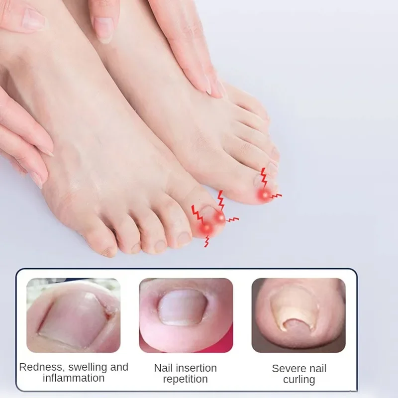 Ingrown Toenail Correction Tool Professional Foot Care Correction Tool Pedicure Recover Embed Toe Nail Treatment Care Foot Tool