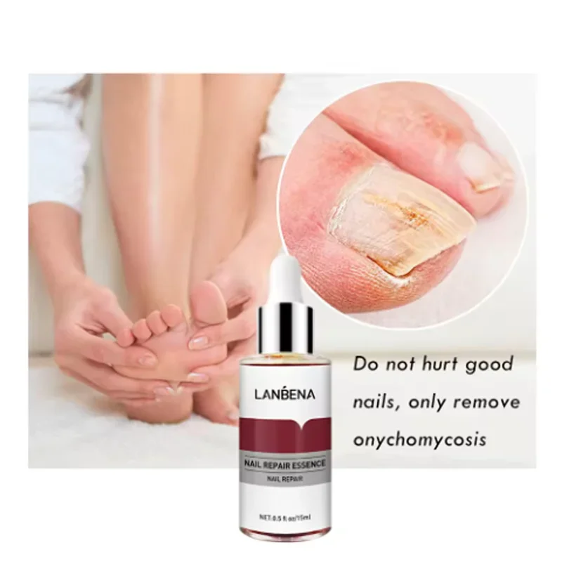 15mlFungus Care Remove Onychomycosis Toes Nourish Brighten Hands Feet Product Repair Suitable Women Nail Pepair Essencs
