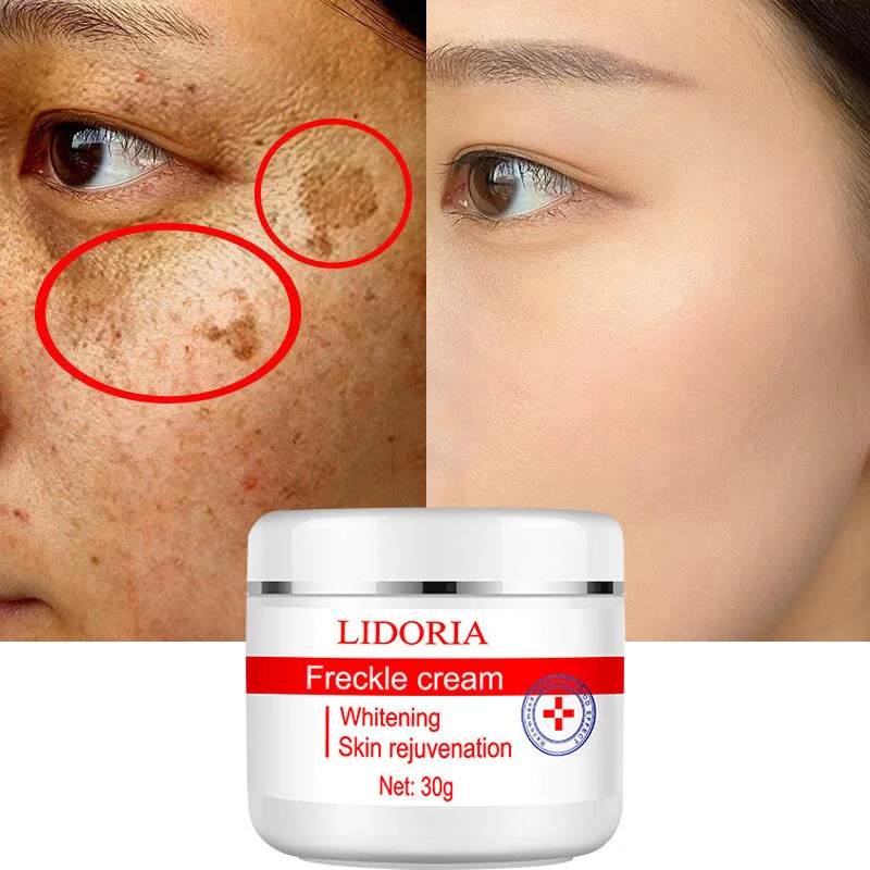 

Whitening Freckle Removing Face Cream Remove Melasma Freckles Lighten Dark Spots Improve Dullness Melanin Remover Brighten Care