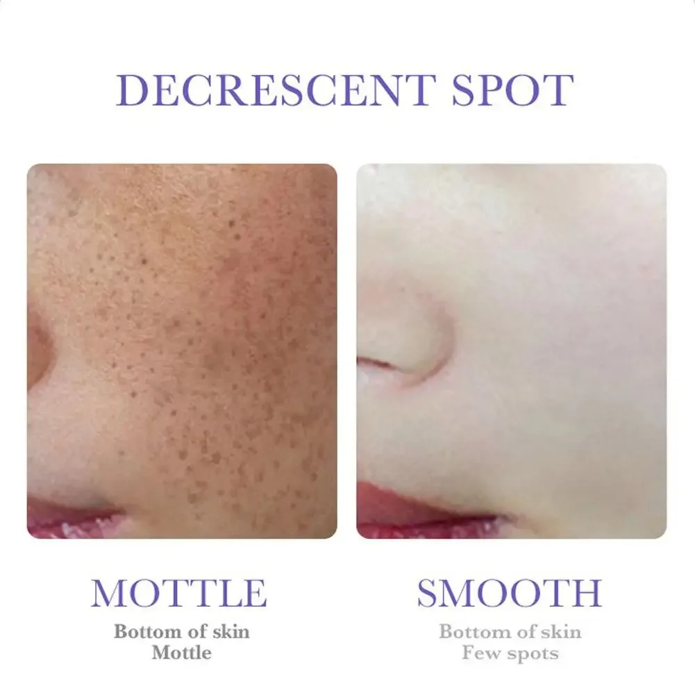 Freckle Removing Cream Nicotinamide Face Cream 3