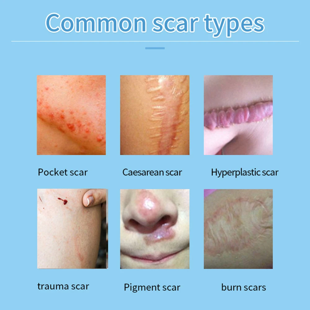 Laser Repair Skin Scars 1-7pcs Powerful Scar Removal Cream Fast Remove Deep Skin Scar Blue Light Therapy Pen Recovery Cream