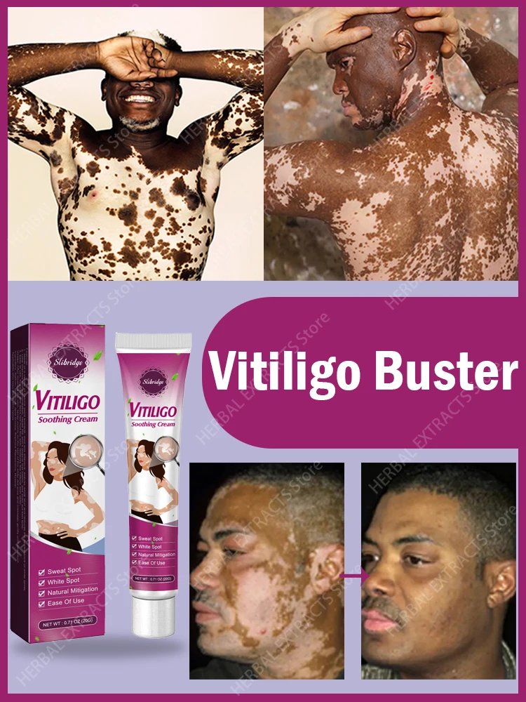 

Успокаивающий Крем для кожи Vitiligo derma relief, Успокаивающий Крем для удаления белых точек