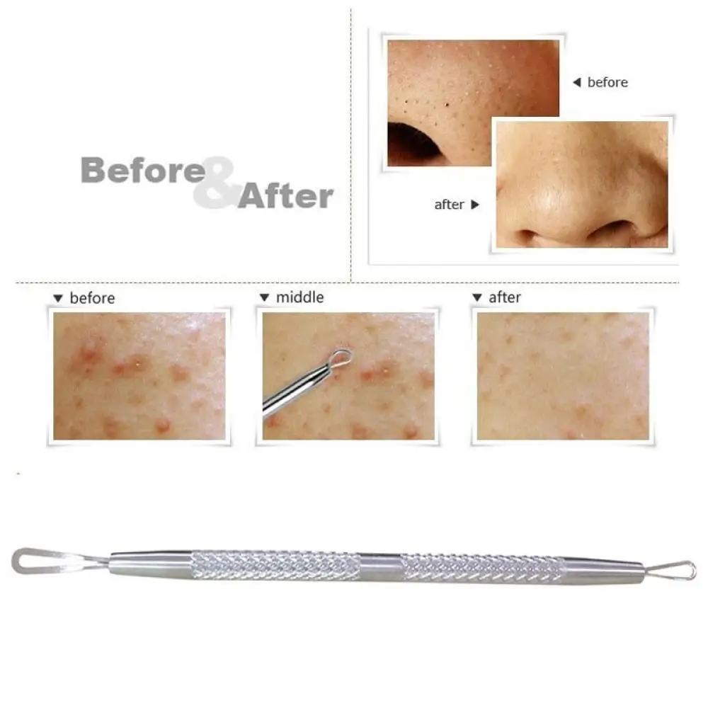 Professional Stainless Steel Blackhead Remover Tool Comedone Acne Pimple 2 Loop Needles Blemish Extractor Remover Skin Care Tool 4