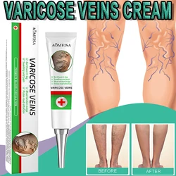 Varicose Veins Cream Removal Varicose Veins Best Against Varicose Veins Products Natural Plant Extracts For Varicose Veins