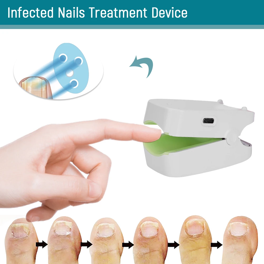 Mini Nail Fungus Laser Treatments Device Painless Fingernails Cure Machine Light Therapy for Fingernails Toenails Onychomycosis
