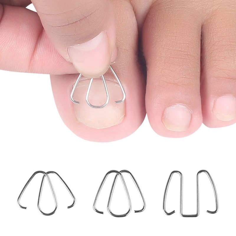 Nail Art Ingrown Toe Nail Correction Tool Toenail Orthosis Paronychia Clip