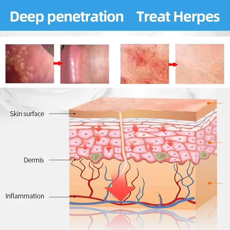 Skin care ointment Antibacterial anti fungal cream Urological herbal gel Balanitis Treatment cream Penis glans Itching Papules Pearl rash Anti infection Genital herpes Spray Skin fungal medicine