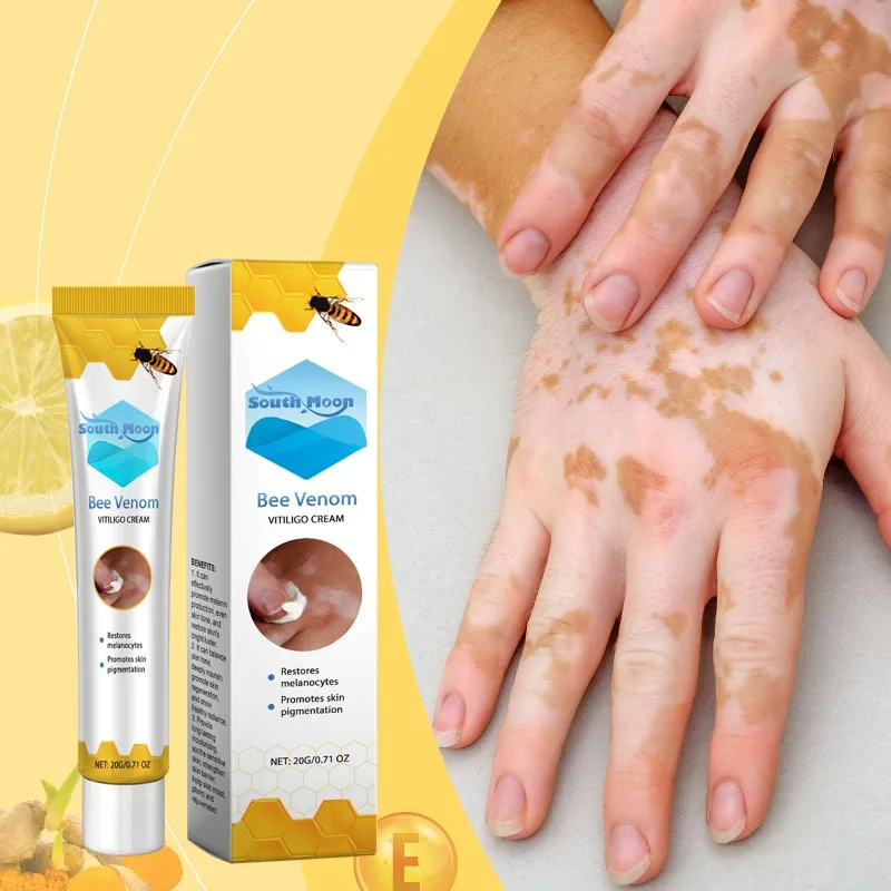 Bee Venom Vitiligo Treatment Cream Eliminate Vitiligo Sweat Spot Antibacterial Mycosis Leukoplakia Cure Moisturizes Care Cream vitiligo ointment