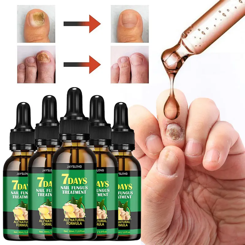 3/5pcs Fungal Nail Serum Toenails Fungus Liquid Anti Infection Remove