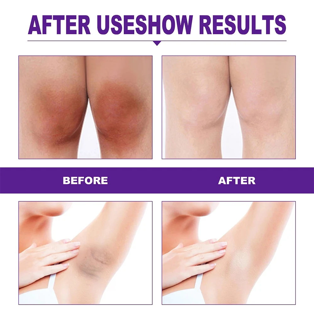 Whitening Cream Private Parts Underarm Bleaching Serum Whiten Butt Knee Brighten Inner Thigh Intimate Parts Dark Remove Melanin 4