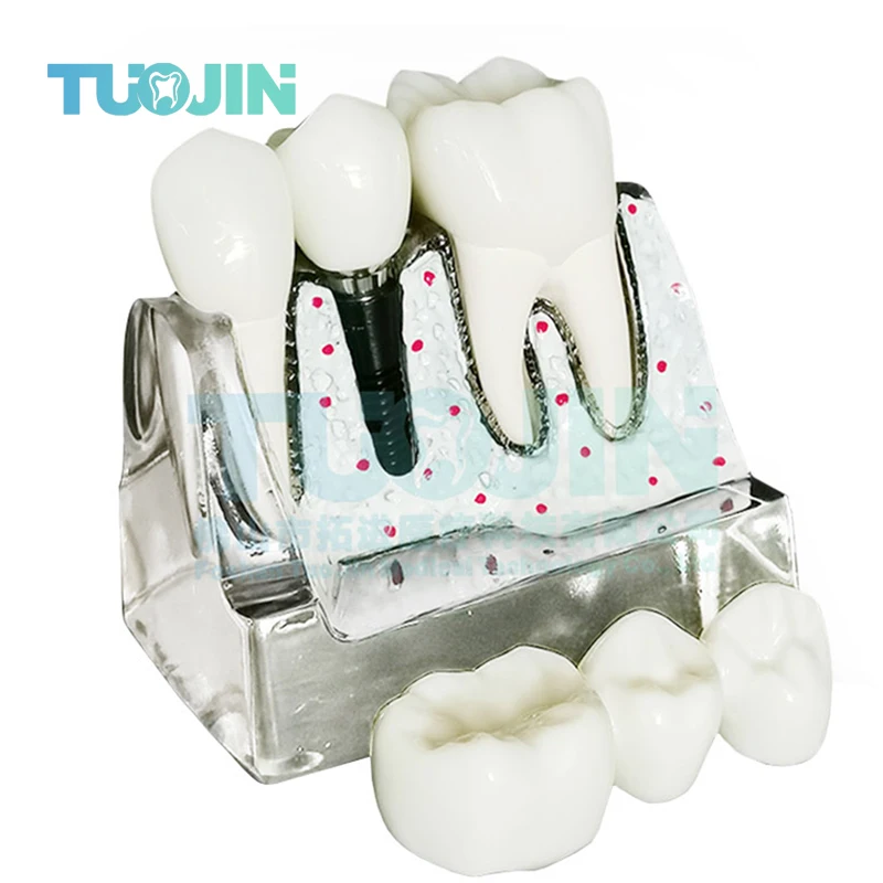 

Dental Implant Model 2.5 Times Dental Implant Demonstration Models Crown Bridge Abutment Removable Dentistry Clinic Tools