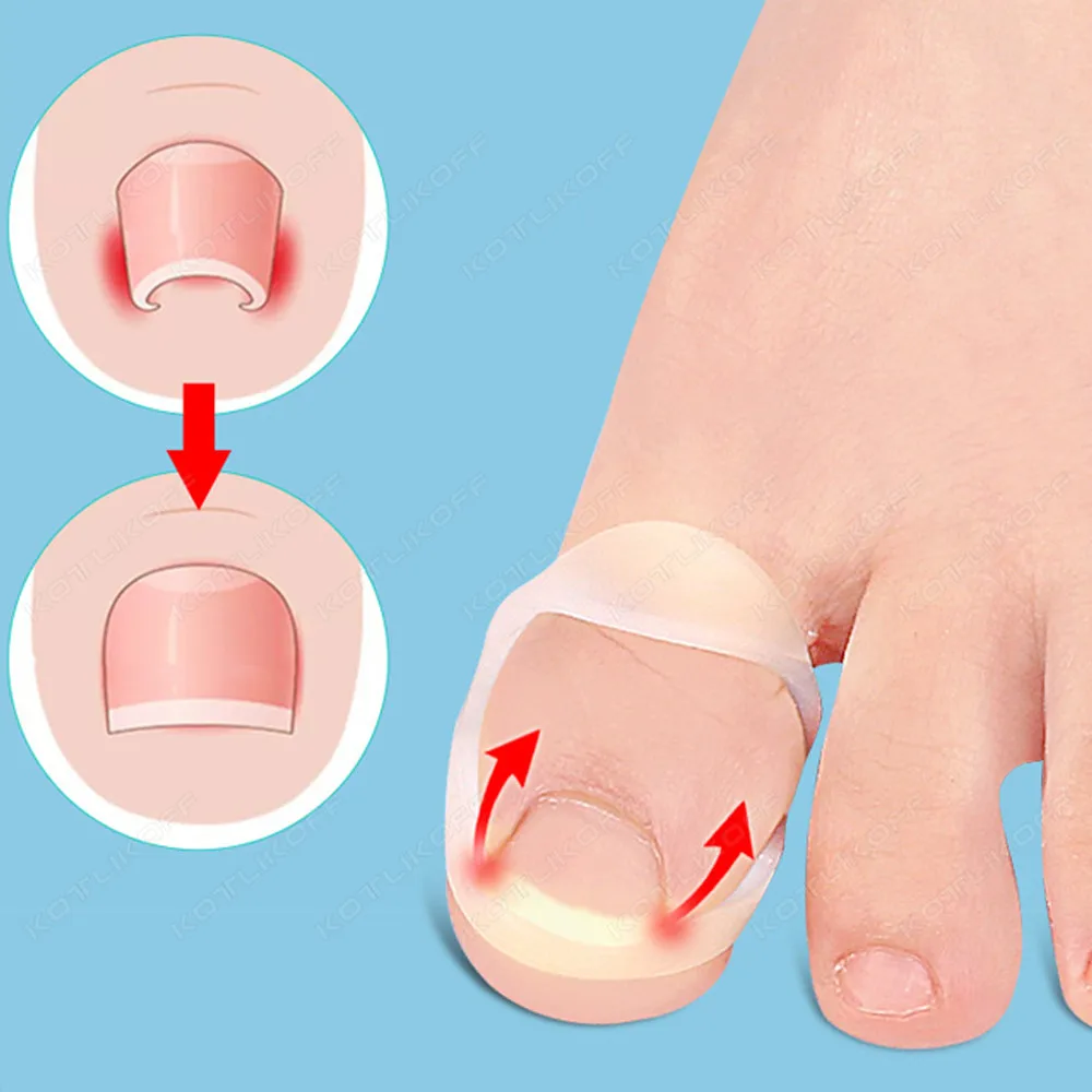 Silicone Ingrown Toenail Correction Tool Invisible Straightening Protector Durable reusable