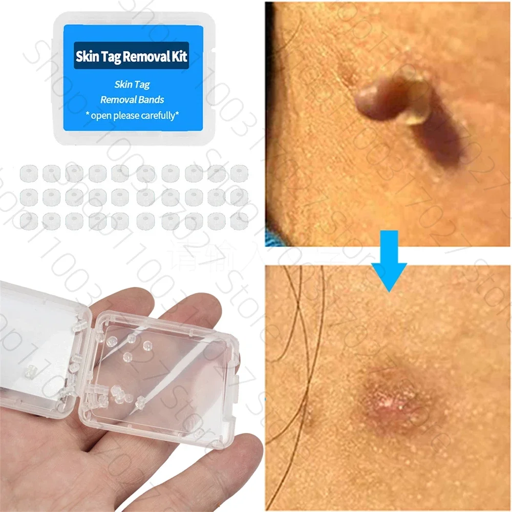 A crioterapia é um tratamento rápido e eficaz para remover verrugas anais  através da aplicação de frio intenso. Seguro e minimamente invasivo, o  procedimento pode ser realizado no próprio consultório e promove, image size:1000x1000