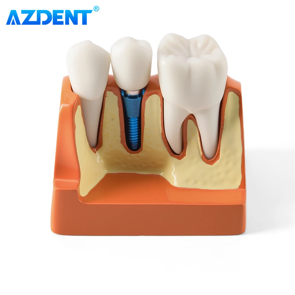 AZDENT 치과 4 배 치아 모델 임플란트 분석 크라운 브리지 데모 이동식 치과 연구 훈련 교육 모델