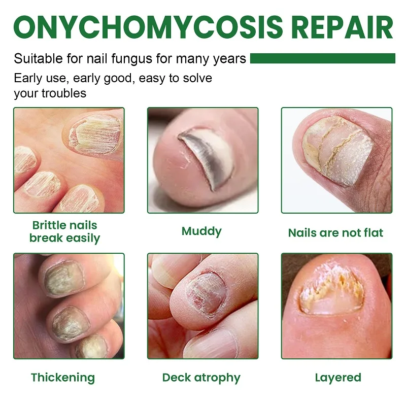 early-onychomycosis