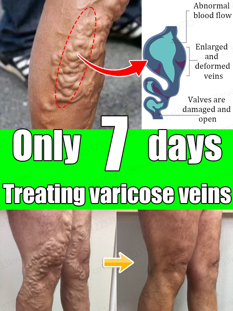 ⱽᵃʳⁱᶜᵒˢᵉ ᵛᵉⁱⁿ ᵒⁱⁿᵗᵐᵉⁿᵗ⸴ ʳᵉᵖᵃⁱʳ ᵛᵃʳⁱᶜᵒˢᵉ ᵛᵉⁱⁿˢ⸴ ⁱᵐᵖʳᵒᵛᵉ ᵖᵃⁱⁿ