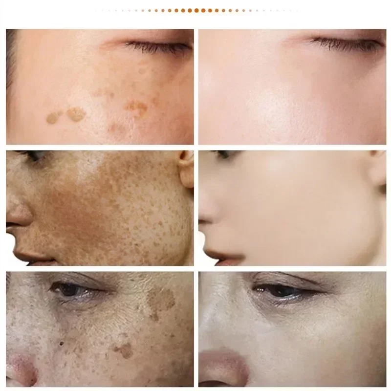 Facial Serum Makeup Cream Anti Wrinkle Cream Niacinamide Melasma Brightening Cream Reduce Melanin Brighten Lighten Dark Skin Chloasma Serum Fade Fine Face Lines