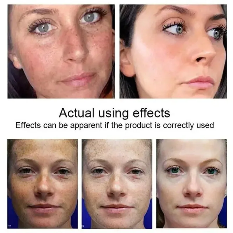 Facial Serum Whitening Serum Kojic Acid Freckle Remover