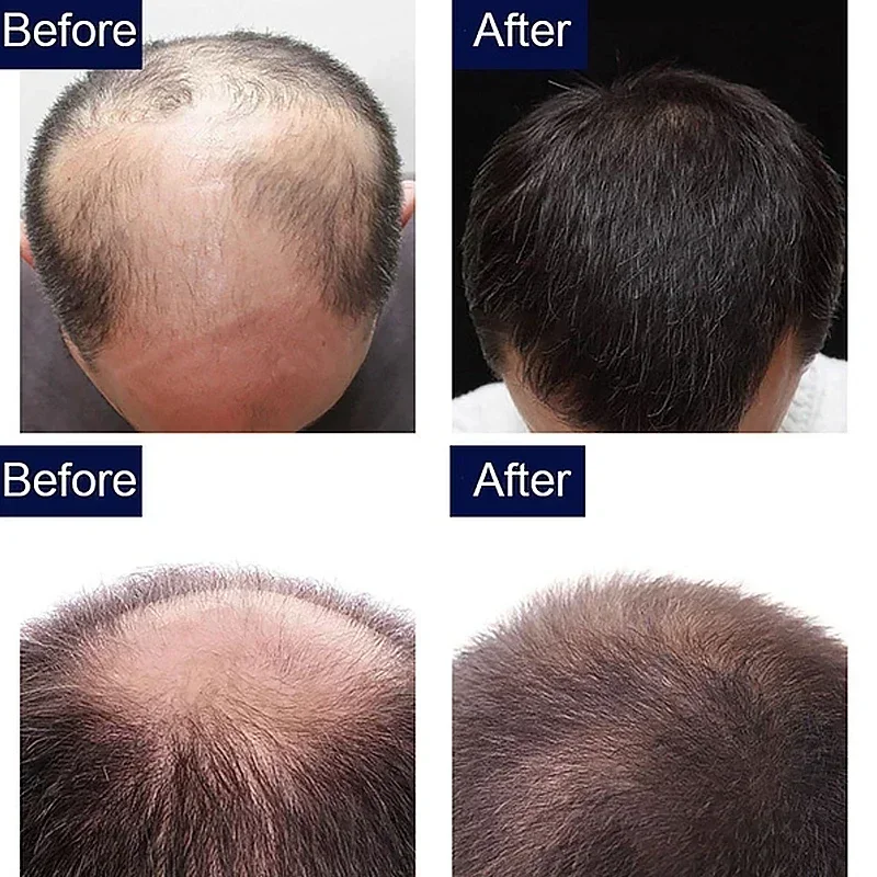 7 Day Fast Hair Growth Oil Ginger Growth Hair Treatment Anti Loss Men Women Scalp Treatment Serum Products Beauty Product hair growth serum hair care oil