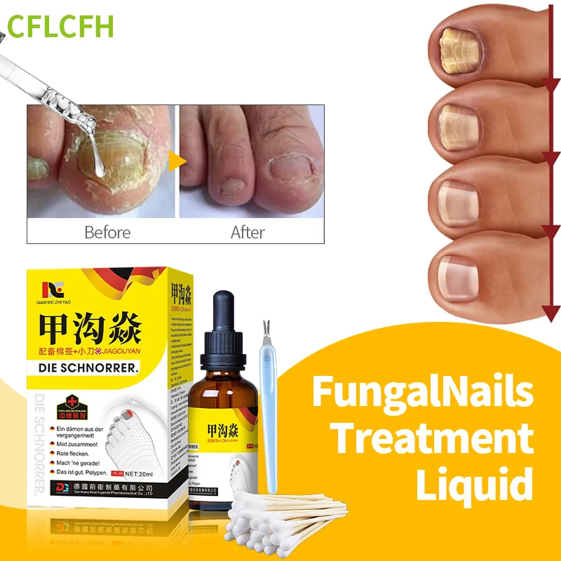 

Nail Fungal Treatment Paronychia Cleaner Toe Onychomycosis Foot Care Medicine German Secret Recipe Nail Fungus Correction Liquid