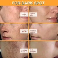 Crème blanchissante pour le visage, élimination des taches de rousseur, Melasma, correcteur de taches foncées, éclaircit la mélanine, Pigmentation, éclaircit, Anti-âge, soins de beauté 2